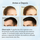 Derma Stamp 120 Agulhas | Microneedling Profundo para Crescimento Capilar e Rejuvenescimento da Pele